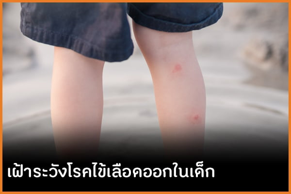 เฝ้าระวังโรคไข้เลือดออกในเด็ก  thaihealth