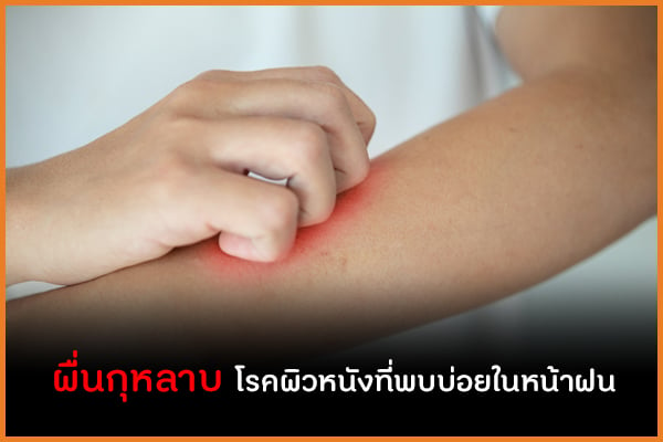 ผื่นกุหลาบ  โรคผิวหนังที่พบบ่อยในหน้าฝน thaihealth